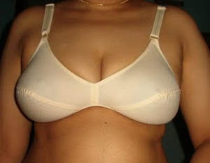 Bra - Breasts inevitably sag